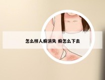 怎么样人癣消失 癣怎么下去