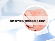 银销病严重吗 银销病是什么引起的