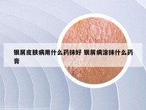 银屑皮肤病用什么药抹好 银屑病涂抹什么药膏