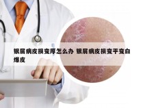 银屑病皮损变厚怎么办 银屑病皮损变平变白爆皮