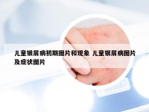 儿童银屑病初期图片和现象 儿童银屑病图片及症状图片