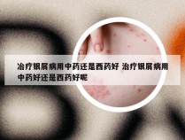 冶疗银屑病用中药还是西药好 治疗银屑病用中药好还是西药好呢