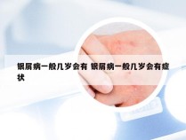 银屑病一般几岁会有 银屑病一般几岁会有症状