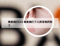 银屑病打b12 银屑病打了13天生物药剂了