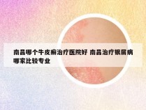 南昌哪个牛皮癣治疗医院好 南昌治疗银屑病哪家比较专业