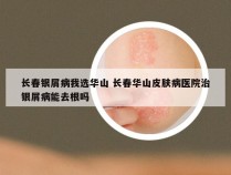 长春银屑病我选华山 长春华山皮肤病医院治银屑病能去根吗