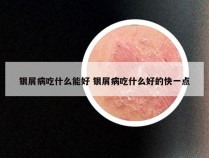 银屑病吃什么能好 银屑病吃什么好的快一点