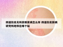 四道街皮炎所依银屑病怎么样 四道街皮肤病研究所地铁在哪个站