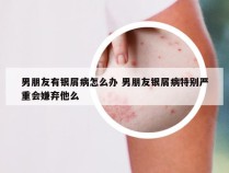 男朋友有银屑病怎么办 男朋友银屑病特别严重会嫌弃他么