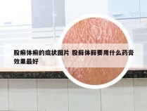 股癣体癣的症状图片 股藓体藓要用什么药膏效果最好