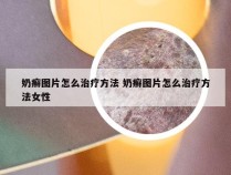 奶癣图片怎么治疗方法 奶癣图片怎么治疗方法女性