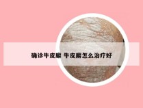 确诊牛皮廨 牛皮廨怎么治疗好