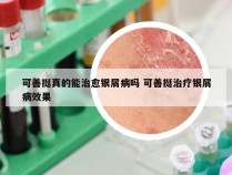 可善挺真的能治愈银屑病吗 可善挺治疗银屑病效果