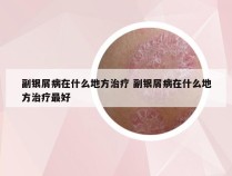 副银屑病在什么地方治疗 副银屑病在什么地方治疗最好