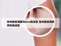 郑州银屑病要询wen杨淑莲 郑州银屑病研究所杨淑莲