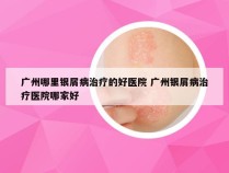 广州哪里银屑病治疗的好医院 广州银屑病治疗医院哪家好