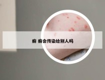 癣 癣会传染给别人吗