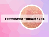 下颌脱皮像癣的图片 下颌掉皮起皱怎么回事