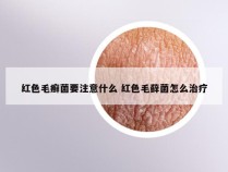 红色毛癣菌要注意什么 红色毛藓菌怎么治疗