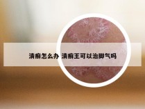 清癣怎么办 清癣王可以治脚气吗