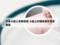 只有小腿上有银屑病 小腿上的银屑病不容易康复