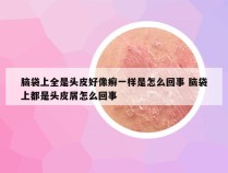 脑袋上全是头皮好像癣一样是怎么回事 脑袋上都是头皮屑怎么回事