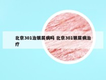 北京301治银屑病吗 北京301银屑病治疗