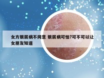 女方银屑病不同意 银屑病可怕?可不可以让女朋友知道