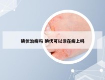 碘伏治癣吗 碘伏可以涂在癣上吗