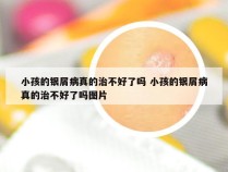 小孩的银屑病真的治不好了吗 小孩的银屑病真的治不好了吗图片