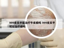 999皮炎平能治疗牛皮癣吗 999皮炎平可以治疗癣吗