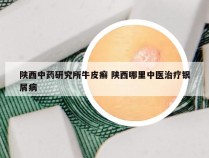 陕西中药研究所牛皮癣 陕西哪里中医治疗银屑病