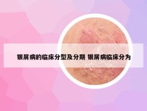 银屑病的临床分型及分期 银屑病临床分为