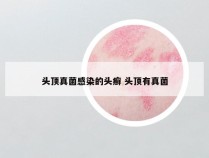 头顶真菌感染的头癣 头顶有真菌