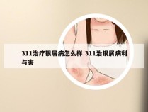 311治疗银屑病怎么样 311治银屑病利与害