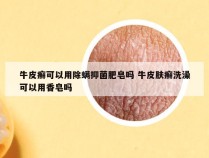 牛皮癣可以用除螨抑菌肥皂吗 牛皮肤癣洗澡可以用香皂吗