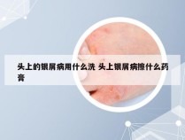 头上的银屑病用什么洗 头上银屑病擦什么药膏