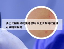 头上长癣用红花油可以吗 头上长癣用红花油可以吗有用吗