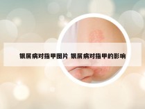 银屑病对指甲图片 银屑病对指甲的影响