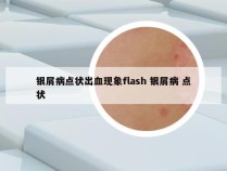 银屑病点状出血现象flash 银屑病 点状