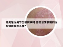 修美乐治关节型银屑病吗 修美乐生物制剂治疗银屑病怎么样?