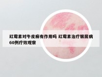 红霉素对牛皮癣有作用吗 红霉素治疗银屑病60例疗效观察