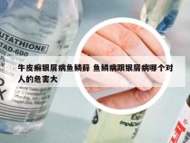 牛皮癣银屑病鱼鳞藓 鱼鳞病跟银屑病哪个对人的危害大