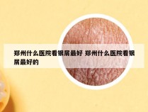 郑州什么医院看银屑最好 郑州什么医院看银屑最好的