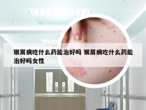 银屑病吃什么药能治好吗 银屑病吃什么药能治好吗女性