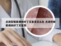 点滴型银屑病快好了又复发怎么办 点滴性银屑病快好了又复发