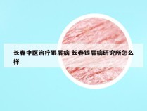 长春中医治疗银屑病 长春银屑病研究所怎么样