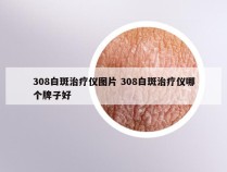 308白斑治疗仪图片 308白斑治疗仪哪个牌子好