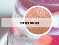 牛皮癣复发特别快