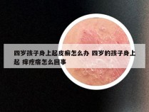 四岁孩子身上起皮癣怎么办 四岁的孩子身上起 痒疙瘩怎么回事